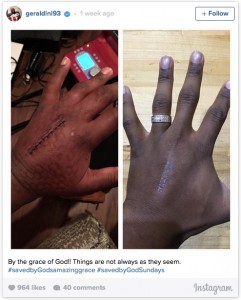 Bucs DT Gerald McCoy's broken hand on McCoy's Instagram